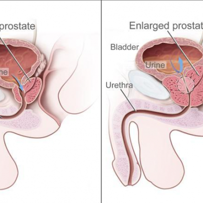Simptomi bolesti prostate i prirodni lijekovi: pelud, kopriva, afrička šljiva, sjemenke bundeve…