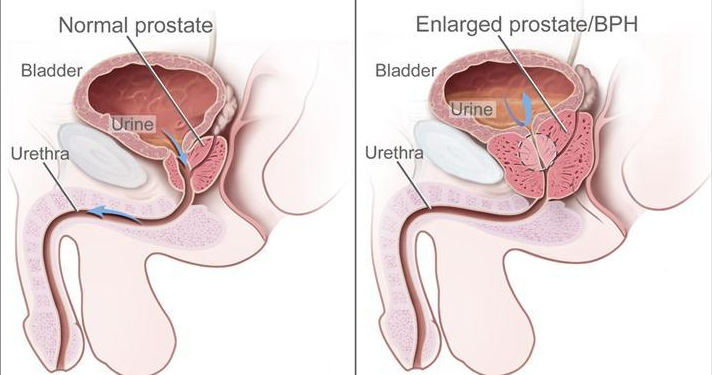 Normalna i uvećana prostata prikaz