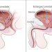 Simptomi bolesti prostate i prirodni lijekovi: pelud, kopriva, afrička šljiva, sjemenke bundeve... prostata Normalna i uvećana prostata prikaz