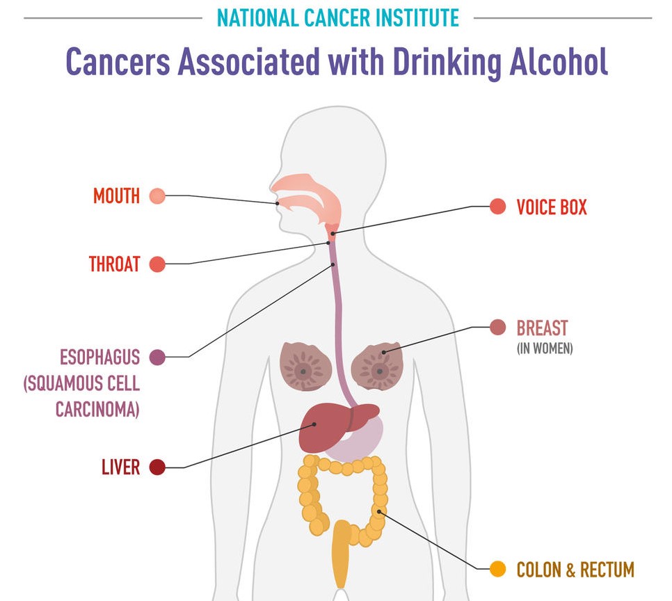 Maligne bolesti koje uzrokuje alkohol / Izvor: cancer.gov/alcohol-fact-sheet